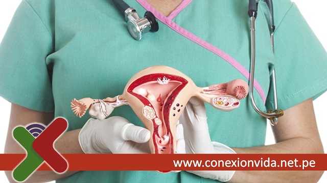 Cáncer de cuello uterino y el VIH - Conexión Vida Cáncer de cuello uterino y el VIH - Conexión Vida