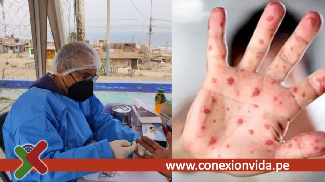 Viruela del Mono Diagnóstico temprano y adherencia al tratamiento antirretroviral para PVVS, son vitales para mantener a raya infecciones oportunistas