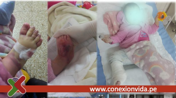 EsSalud Llevan a su hija por un dolor de cabeza, pero termina con quemadura química en el pie